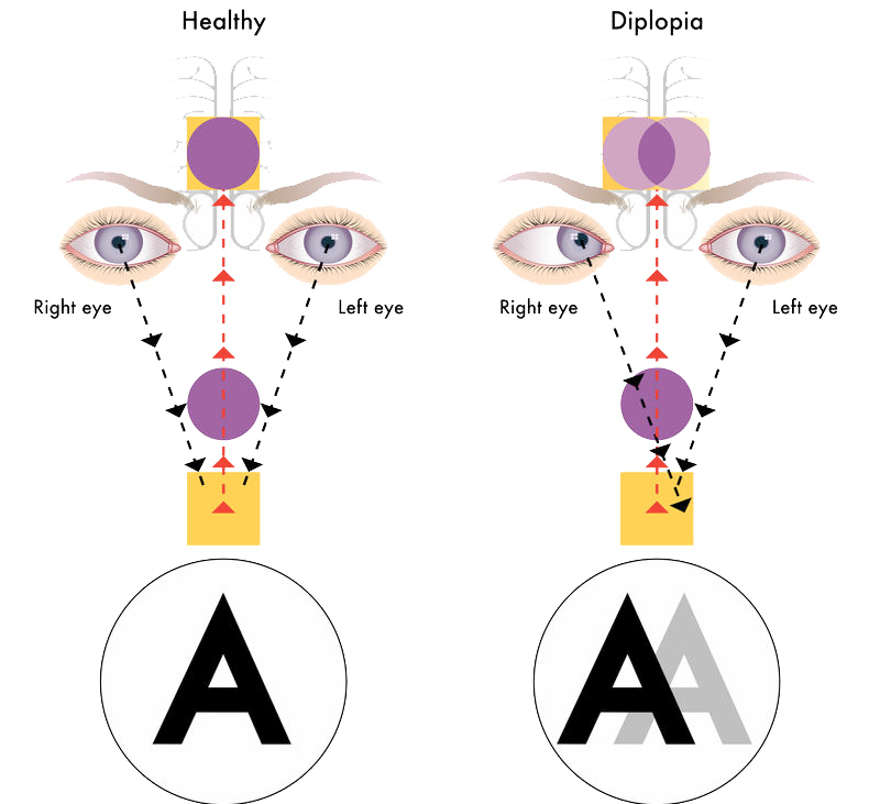 Психосоматика глазных заболеваний