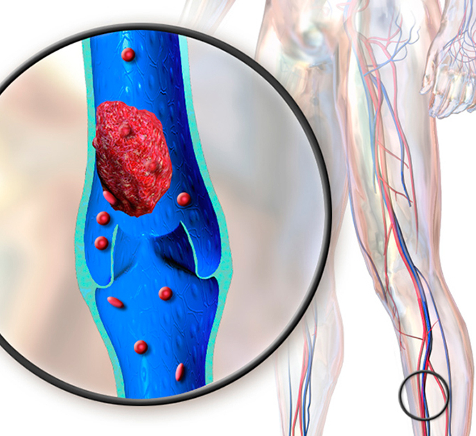 Варикоз Тромбоз Фото