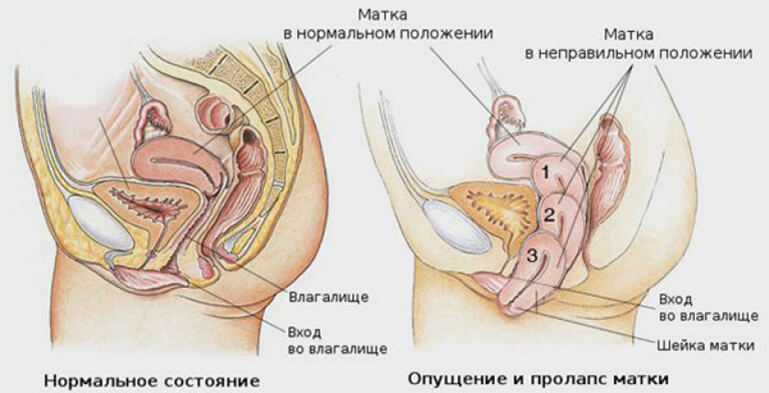 Опущение матки и органов малого таза: 5 упражнений, которые помогут
