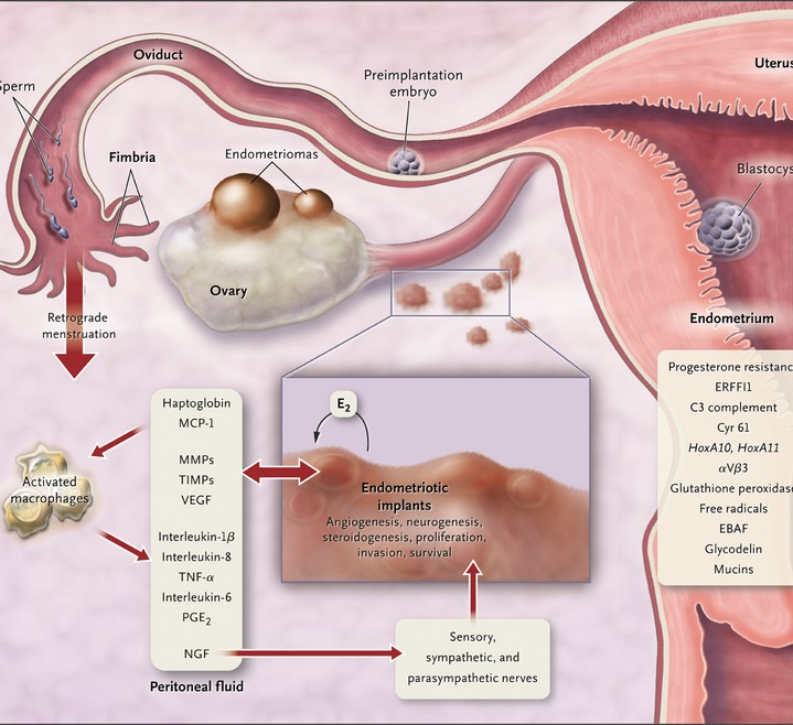 Женское здоровье: эндометриоз и киста яичников