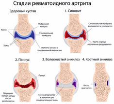 Как перевести РЕВМАТОИДНЫЙ артрит в стадию ремиссии