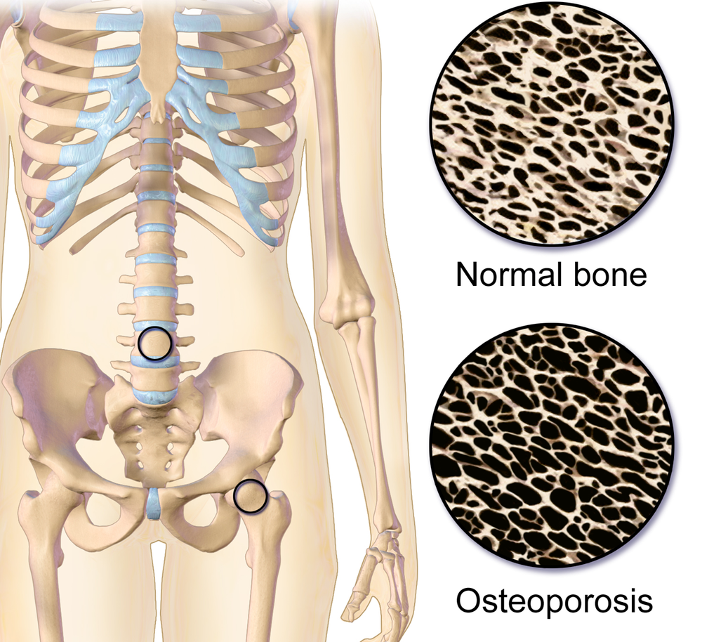 Bone mineral. Остеопороз кости. Костный ткань нормальная и остеопороз. Нормальная кость и остеопороз.