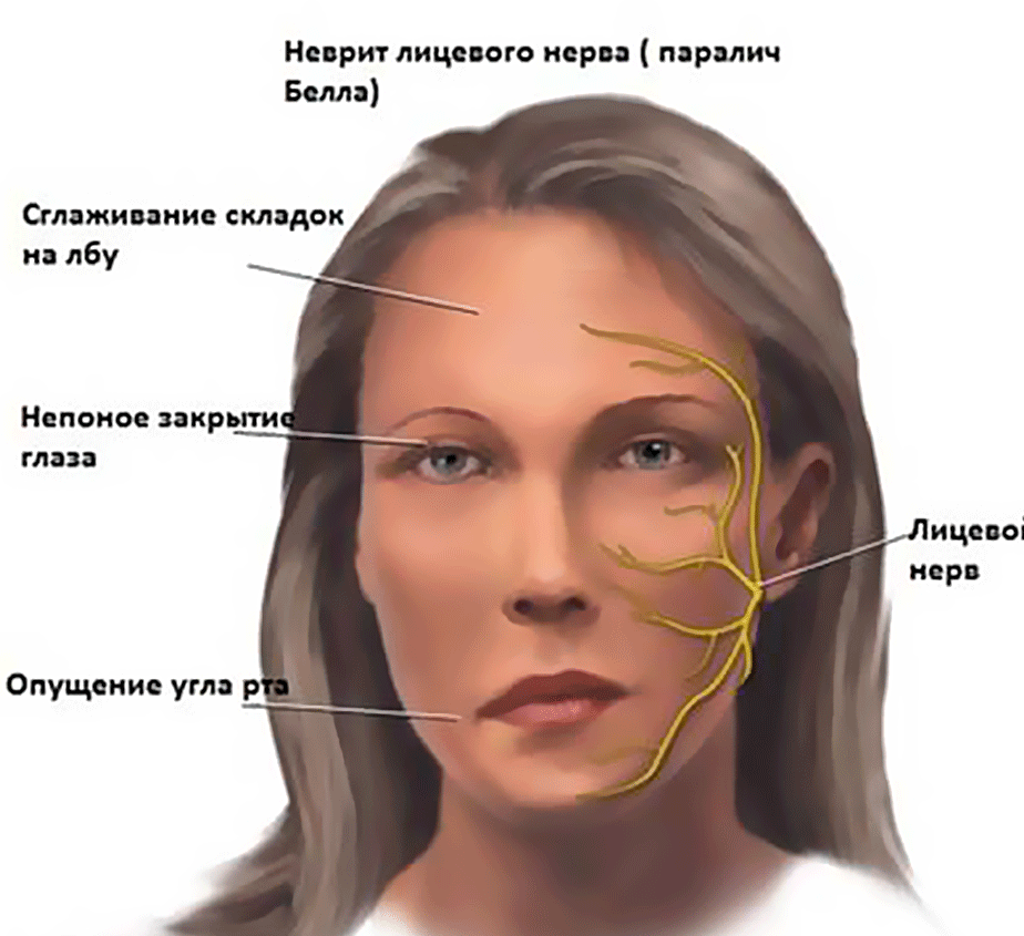 Неврит лицевого нерва видео