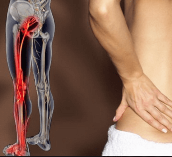 Воспаление седалищного нерва - симптомы и лечение защемления седалищного нерва