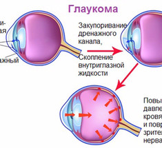 Глаукома: почему возникает и как предотвратить заболевание