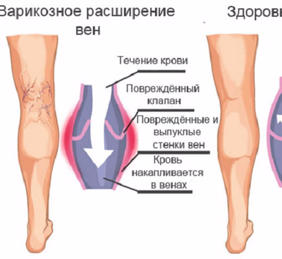 Чем лечить варикоз вен на ногах