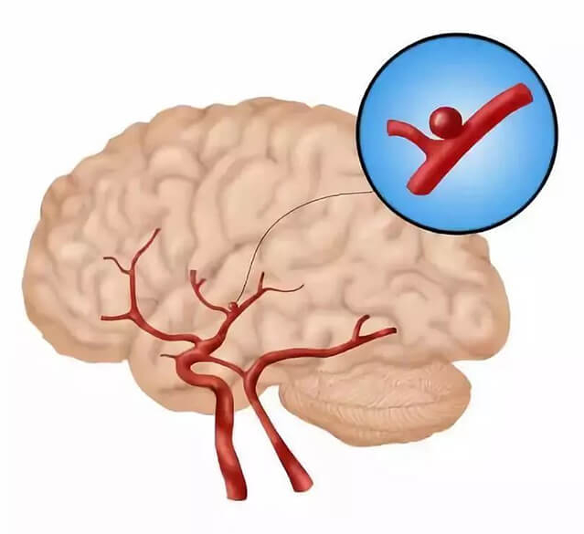 Презентация аневризмы сосудов головного мозга