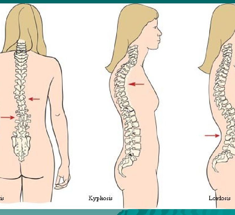 Лордоз кифоз сколиоз картинки