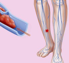 Внимание! Первые симптомы тромба в ноге