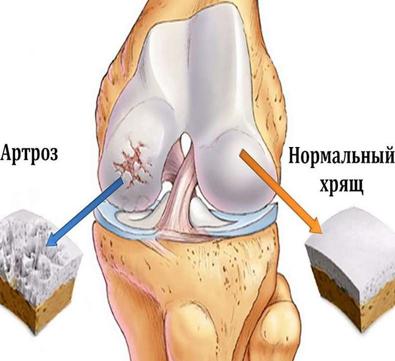 Артроз коленного сустава рисунок