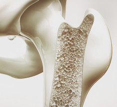 Как предотвратить остеопороз?
