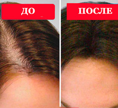 Живица – чудо-средство от выпадения волос