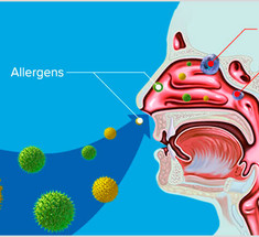 Аллергия – болезнь из детства