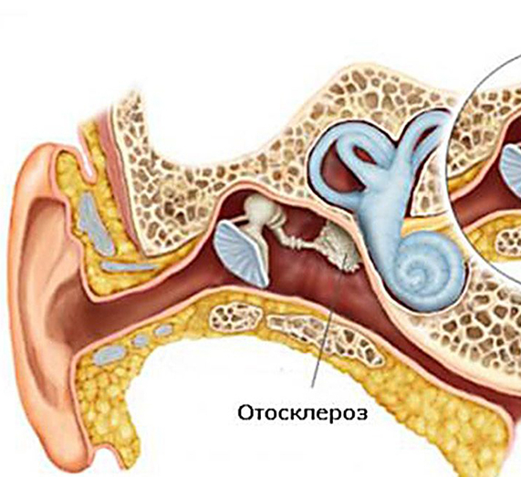 Ostorozhno Otoskleroz