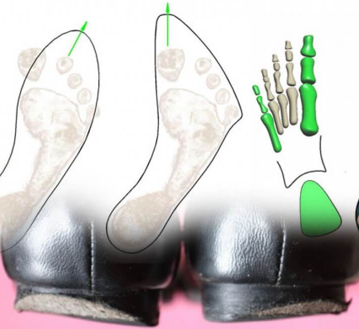 Как стаптывается обувь при плоскостопии