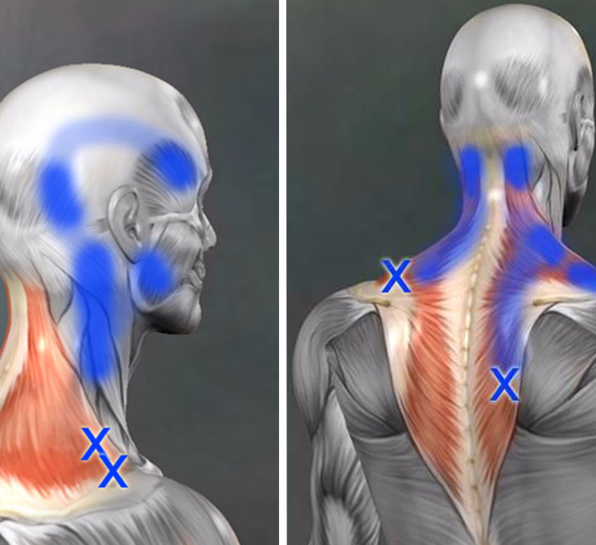 Триггерные точки на спине и шее