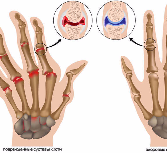 Как лечить артроз пальца кисти. Как лечить артроз пальца кисти. Узелки гебердена ревматоидный артрит. Как лечить артроз пальца кисти. Межфаланговые суставы кисти.