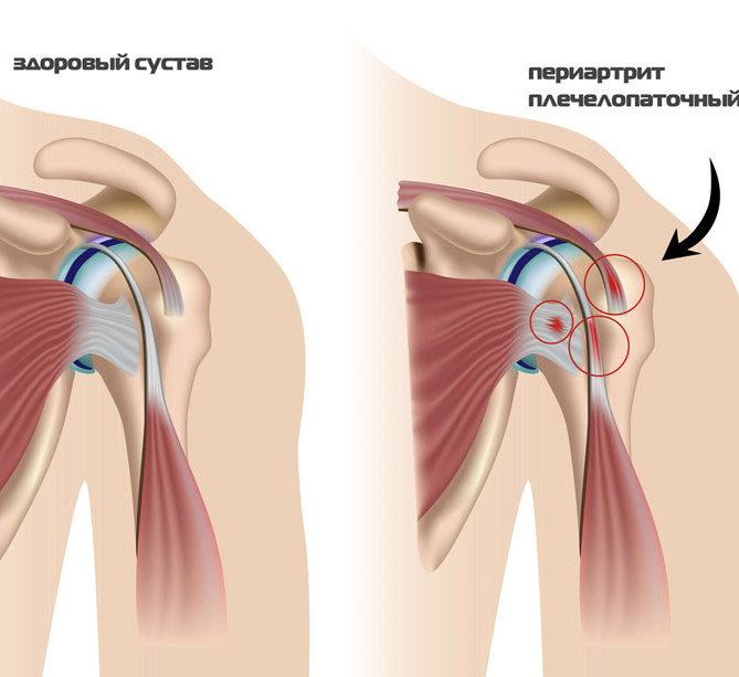 Комплекс упражнений Попова при плечелопаточном периартрите