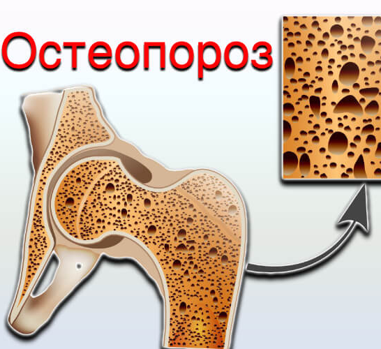 Остеопороз стопы фото