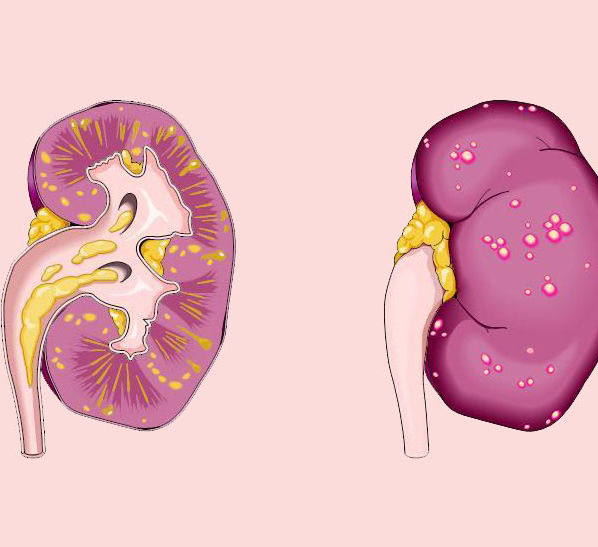 Хронический пиелонефрит картинки