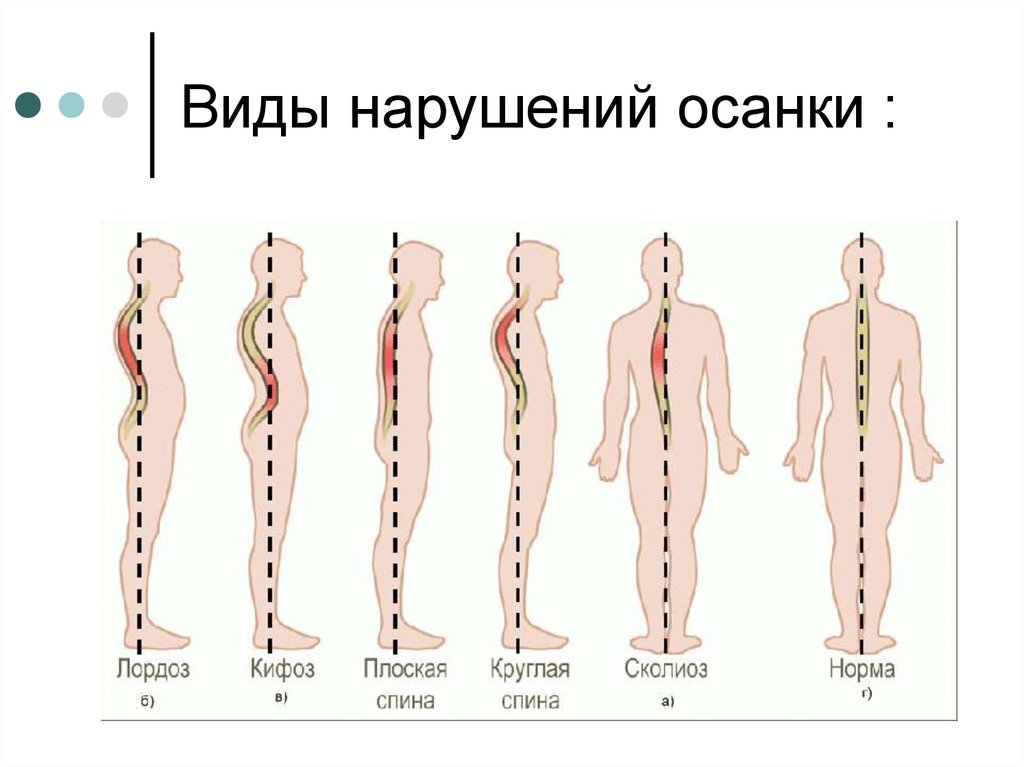 Лордоз кифоз сколиоз рисунок