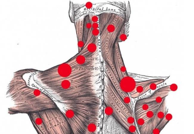 Триггерные точки на спине схема