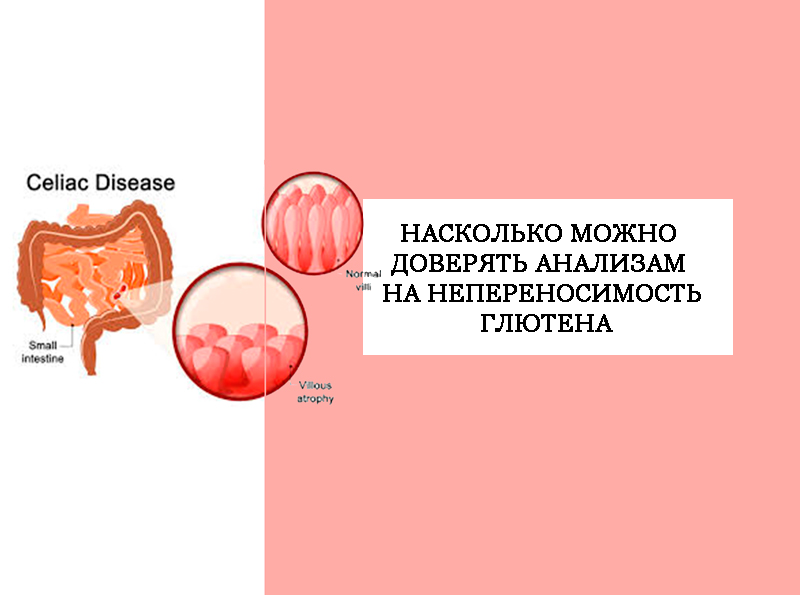 Аллергия на глютен. Чувствительность к глютену и целиакия. Анализ на чувствительность к глютену. Кровь на целиакию. Гиперчувствительность к глютену.