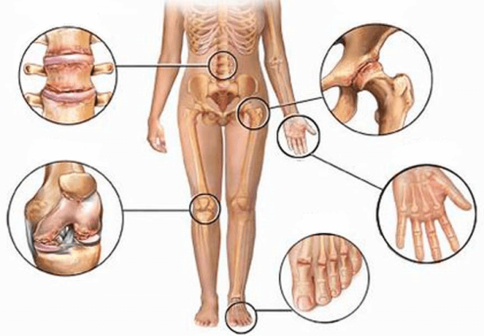 Боль в суставах: 5 натуральных противовоспалительных средств