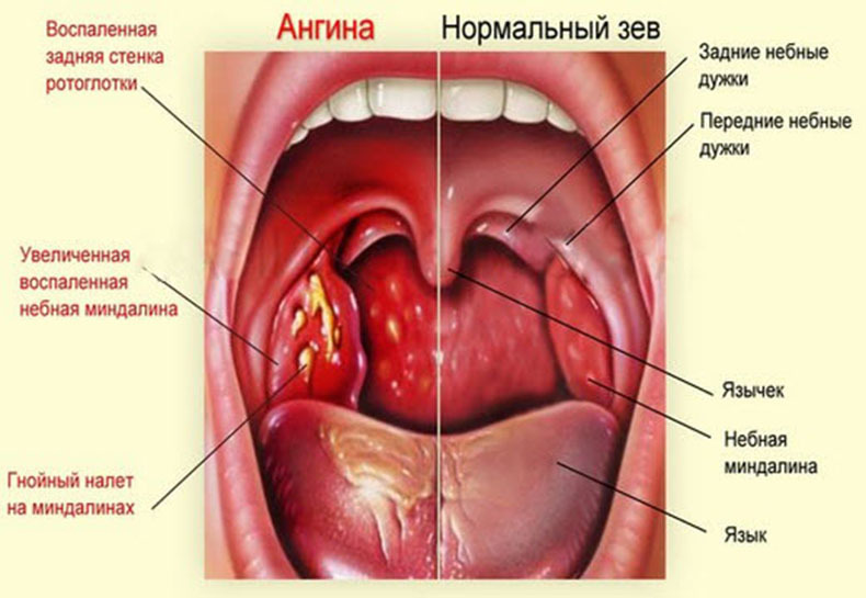 Можно ли снимать гной с миндалин при ангине перекисью водорода thumbnail