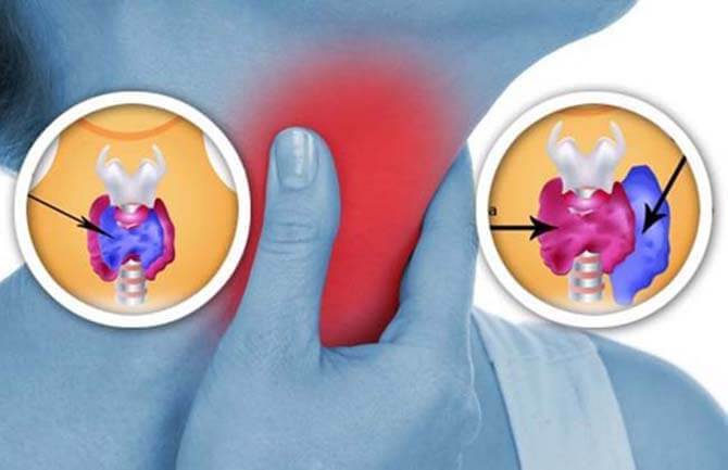 Щитовидная железа: 8 вещей в Вашем доме, которые наносят ей вред