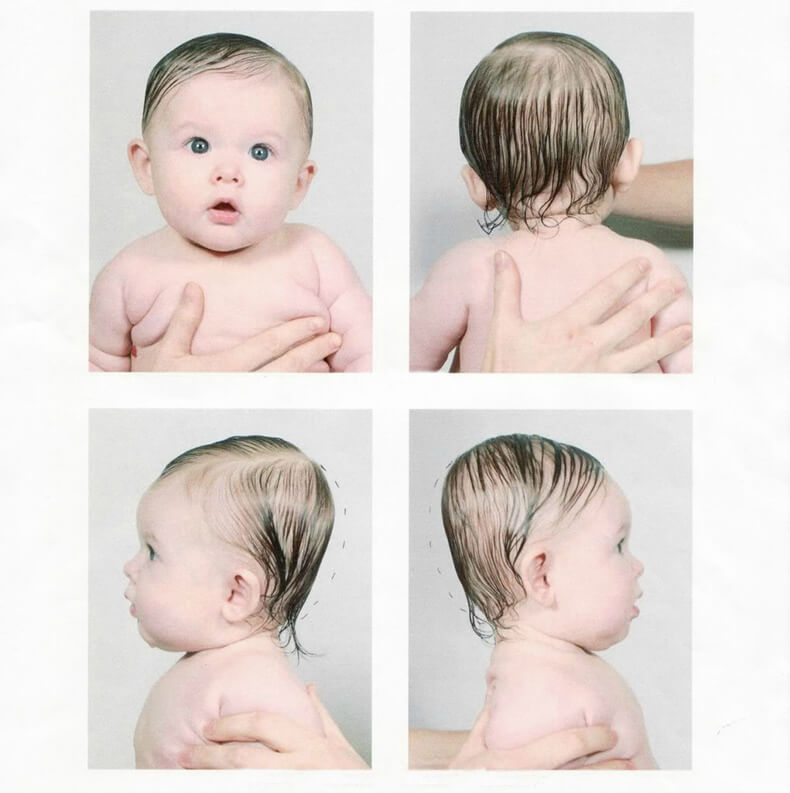 Кривошея у новорожденных фото как понять