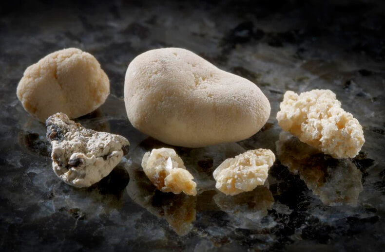 Камни в почках: продукты, которые провоцируют их появление