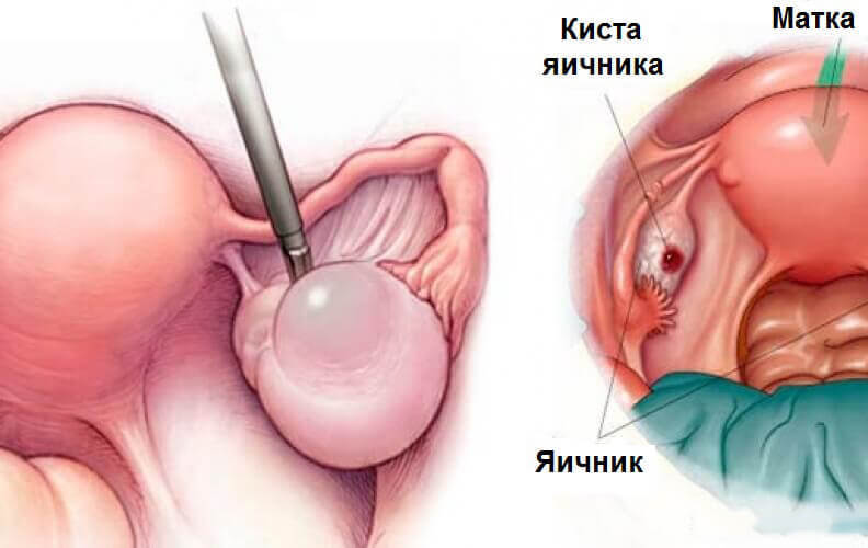 При кисте яичника может быть жжение во влагалище thumbnail