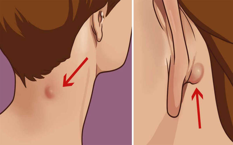 Что нужно знать, если у вас есть такое уплотнение на шее или за ухом