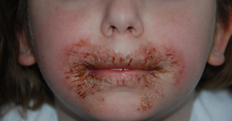 Аллергия на лице от влажных салфеток thumbnail