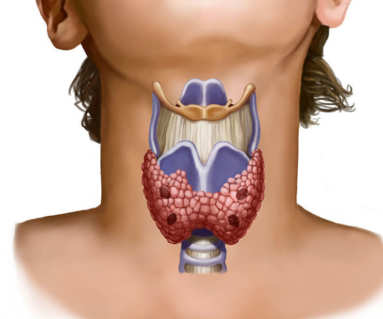 При болезни щитовидной железы может быть температура thumbnail