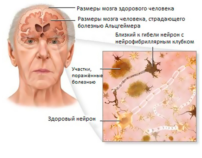 Как уберечься от болезни Альцгеймера