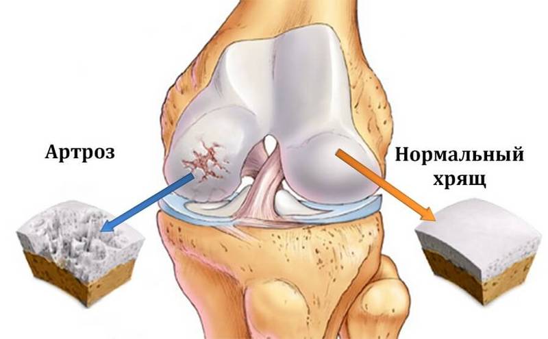 Изображение - Бубновский лечение артроза коленного сустава content_4