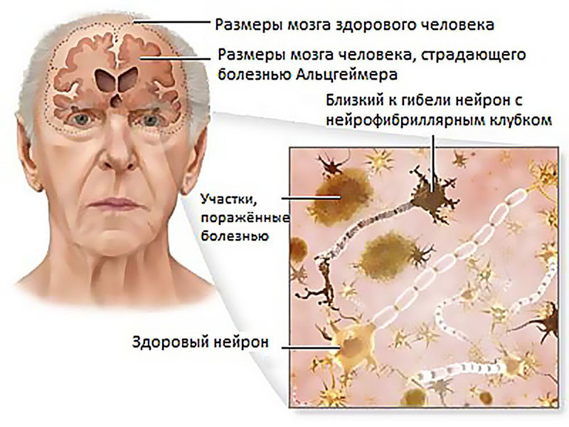 Как предотвратить болезнь Альгеймера 