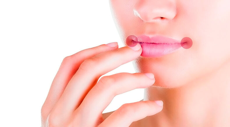 Ангулит: лечение трещинок в уголках губ