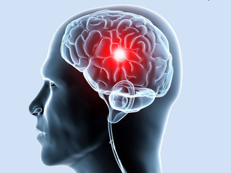 Заболевания сосудов головного мозга, о которых следует знать