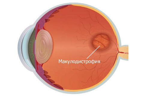 Тест Амслера: как вовремя выявить заболевание глаз