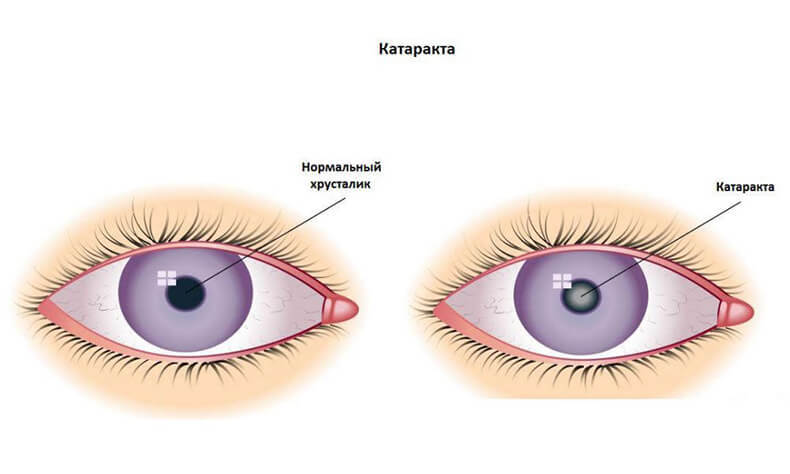 8 важных вещей, которые нужно знать о катаракте
