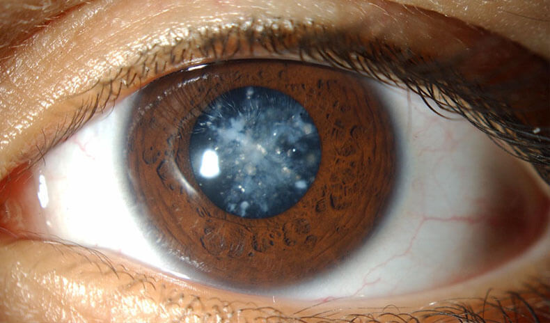 8 важных вещей, которые нужно знать о катаракте
