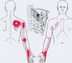 Карта триггеров: точки боли и точки напряжения мышц 