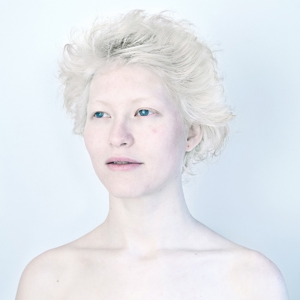 Человек с самой светлой. Монголоиды альбиносы. Rosie Crawford альбинос. Альбинизм патанатомия. Альбинизм энзимопатия.