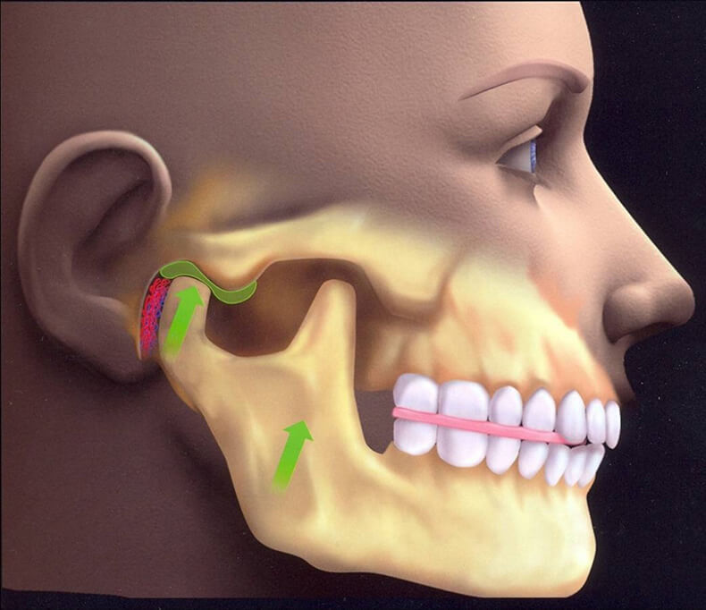 Напряжение в нижней челюсти при неврозе