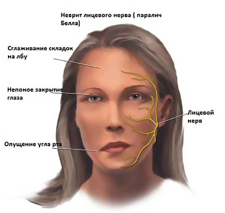 Неврит тройничного нерва карта вызова