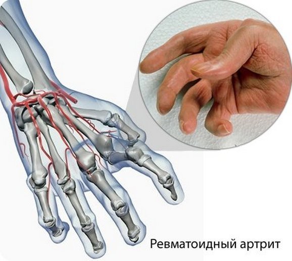 Ревматоидный артрит левой руки thumbnail