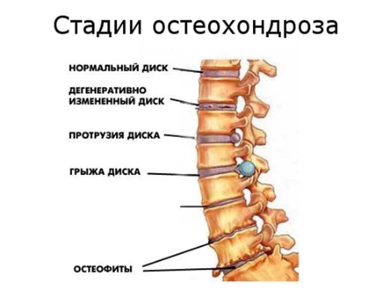 Схема лечения зппп у женщин